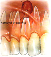 Diagram showing removal of root tip.