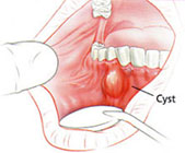 Diagram of a cyst inside the mouth.